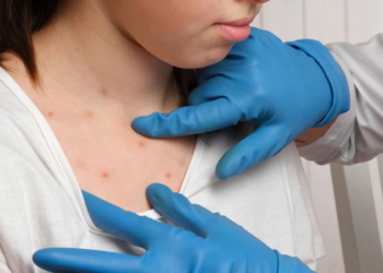 ТҮРКІСТАНДА ВАКЦИНАДАН БАС ТАРТҚАН 47 АЗАМАТ ҚЫЗЫЛШАМЕН АУЫРДЫ