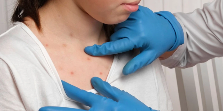 ТҮРКІСТАНДА ВАКЦИНАДАН БАС ТАРТҚАН 47 АЗАМАТ ҚЫЗЫЛШАМЕН АУЫРДЫ